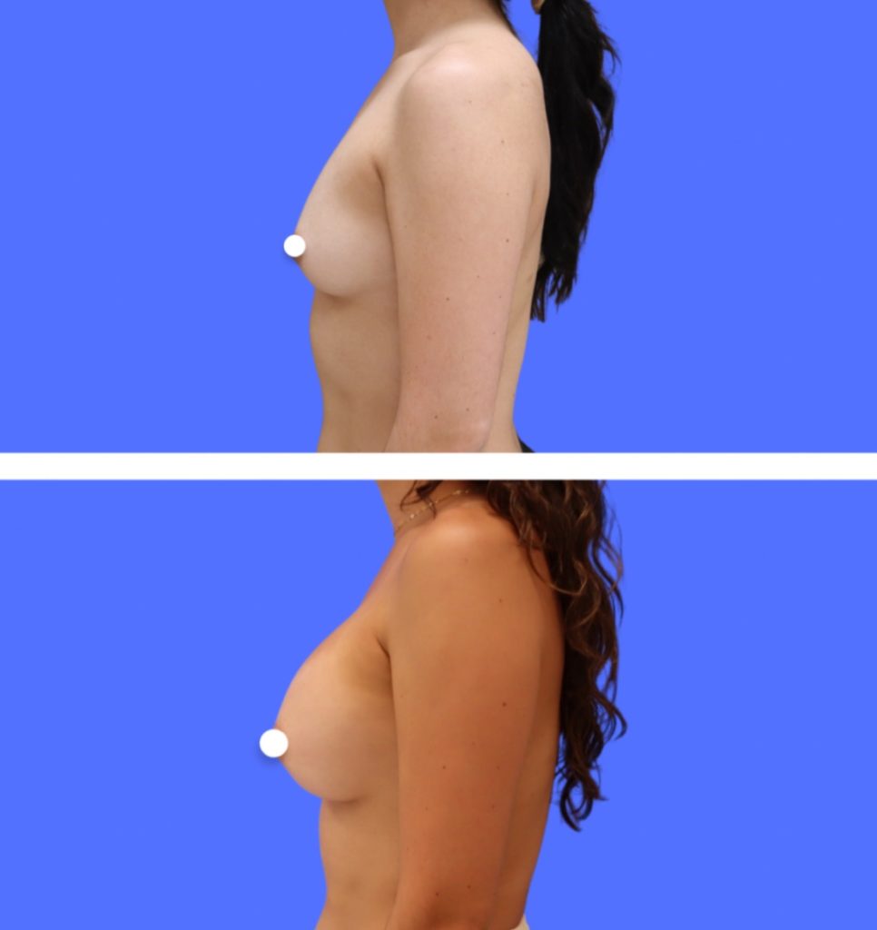 Before and After - Breast Augmentation