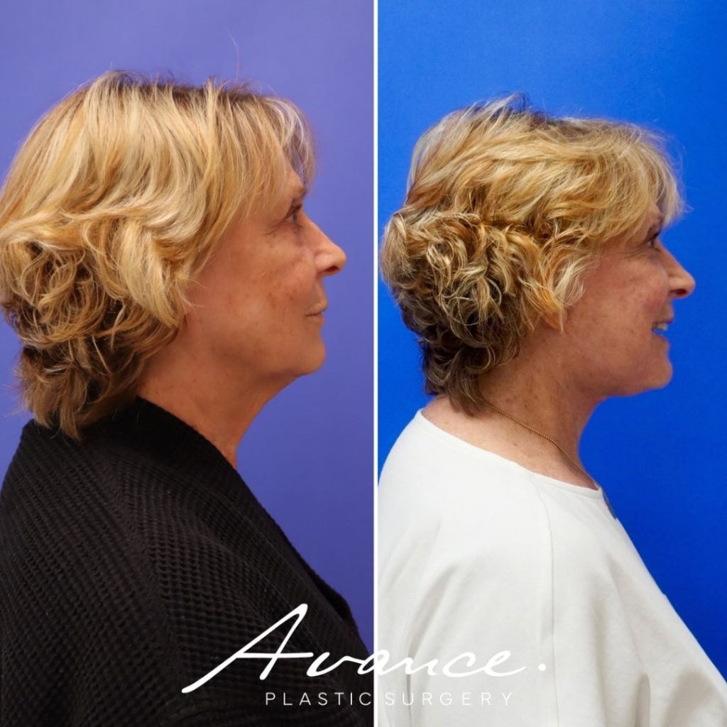 Before and After - Bleferoplastia inferior