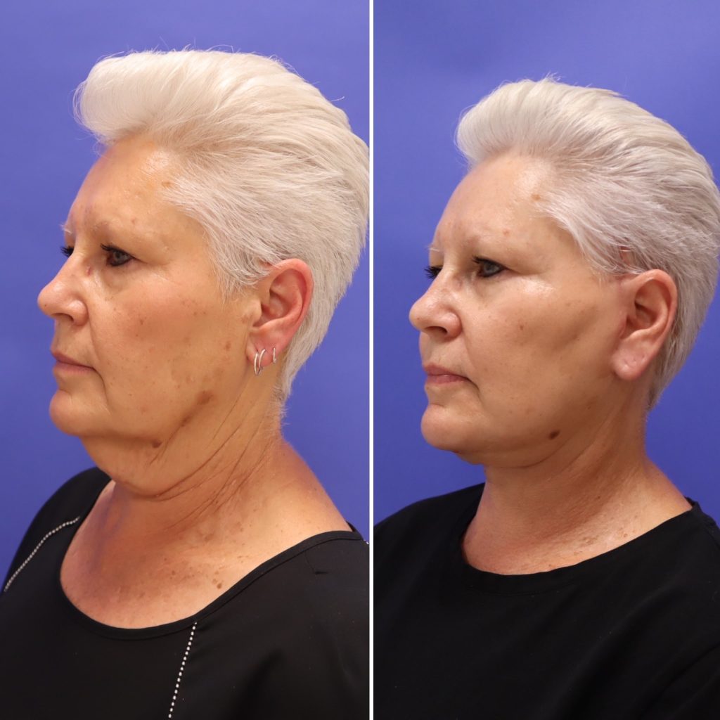 Before and After - Mini Face/Necklift