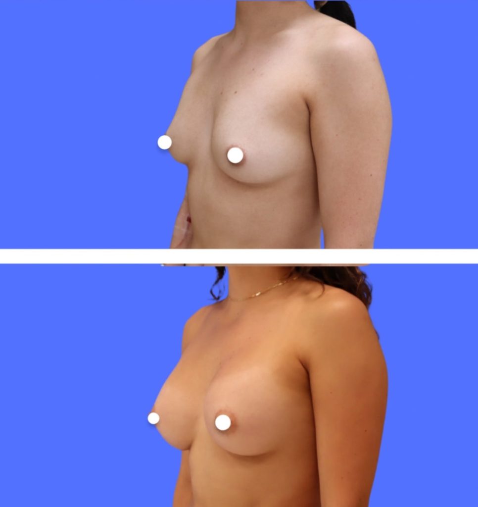 Before and After - Breast Augmentation