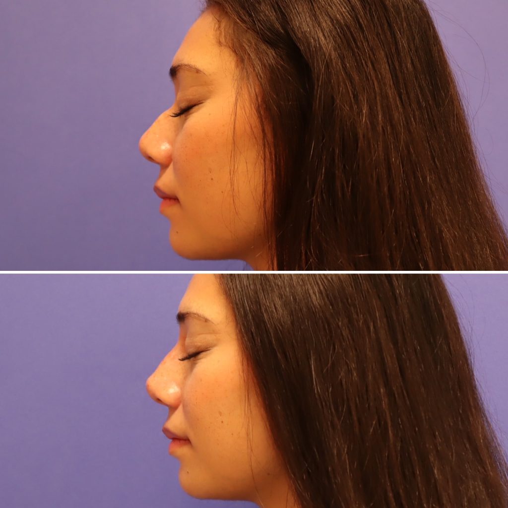 Before and After - Rinoplastia no quirúrgica