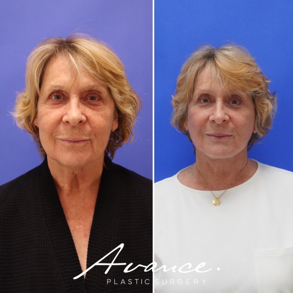 Before and After - Bleferoplastia inferior