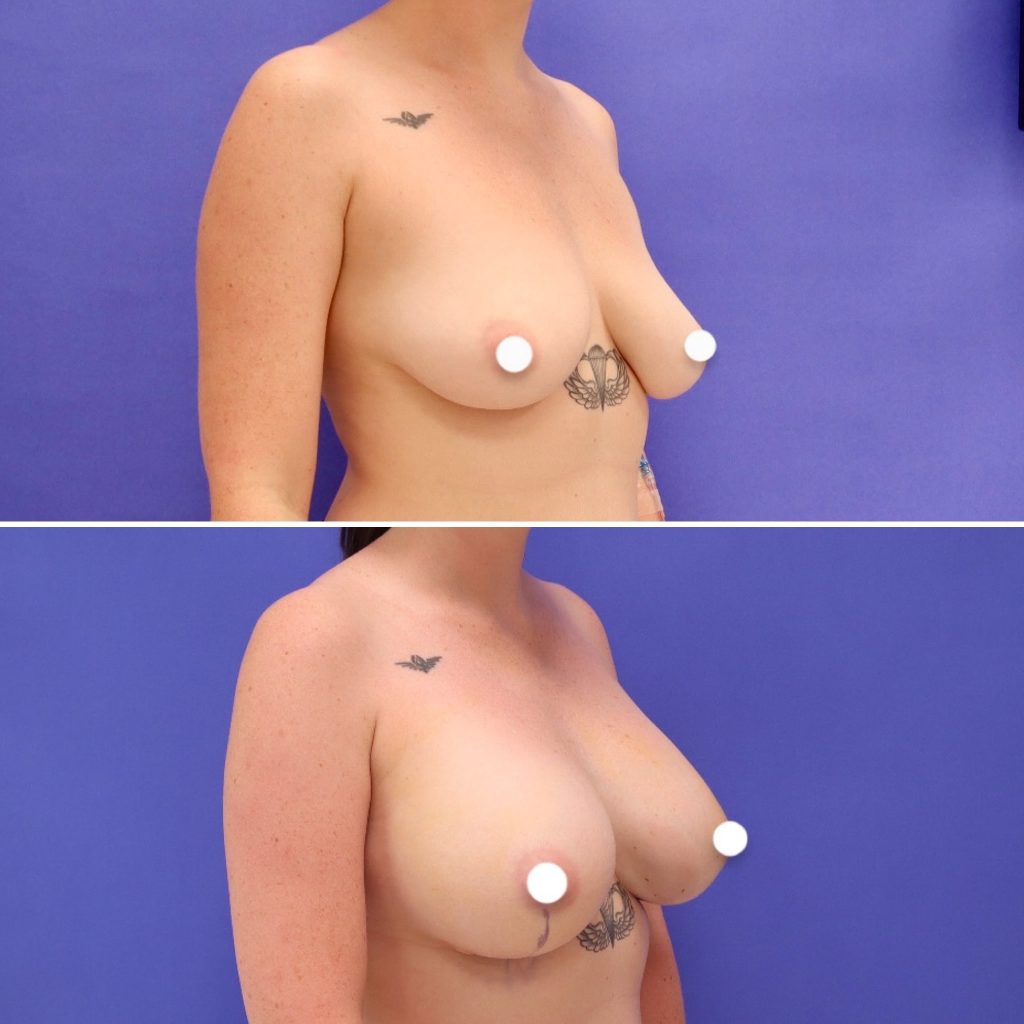 Before and After - Breast Augmentation