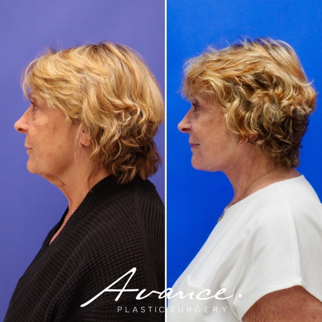 Before and After - Bleferoplastia inferior