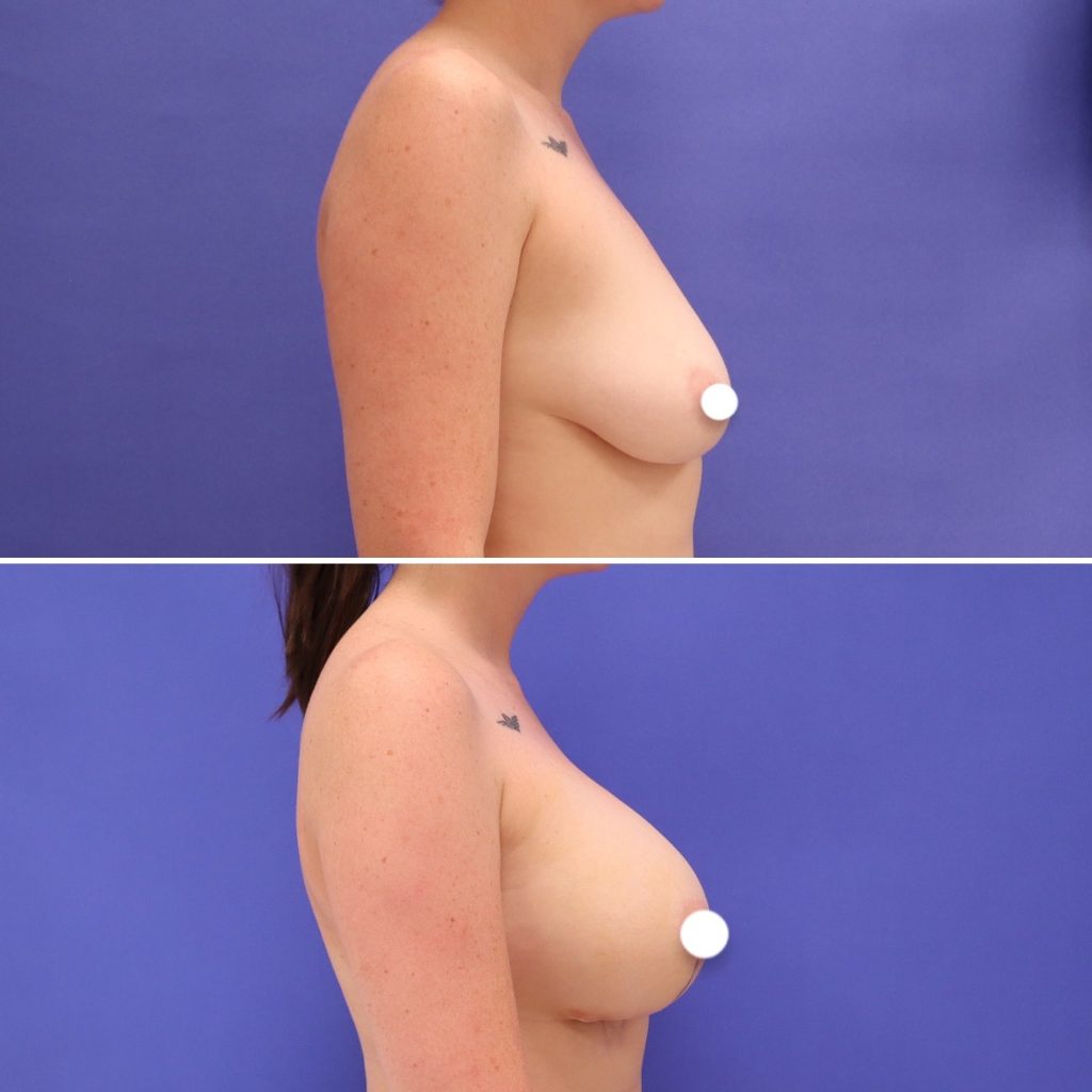 Before and After - Breast Augmentation