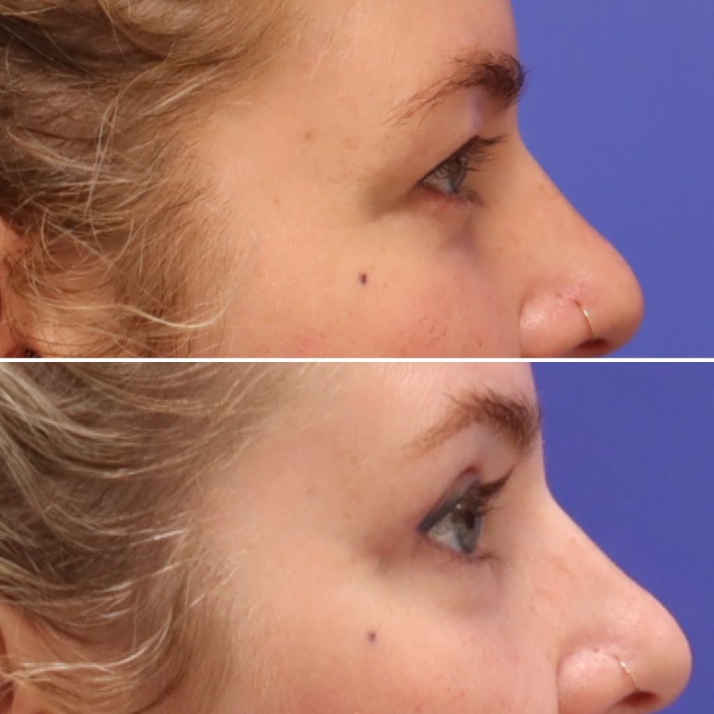 Before and After - Upper Blepharoplasty