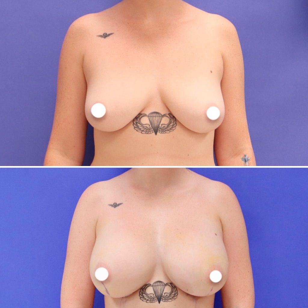 Before and After - Breast Augmentation