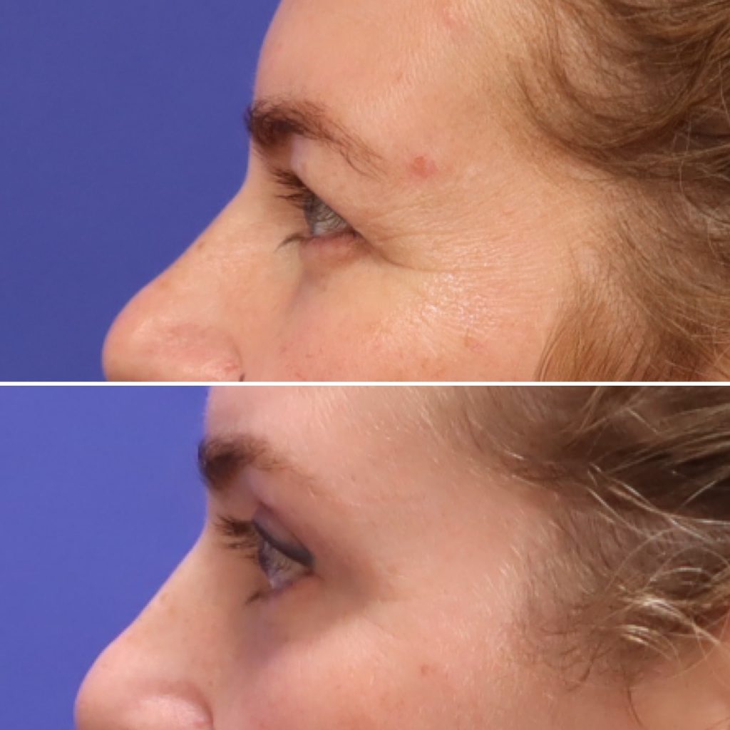 Before and After - Blefaroplastia superior