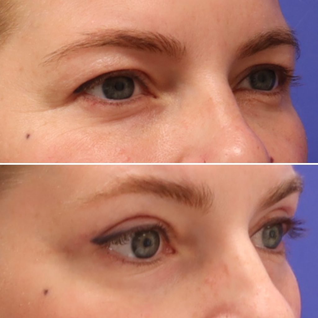 Before and After - Blefaroplastia superior