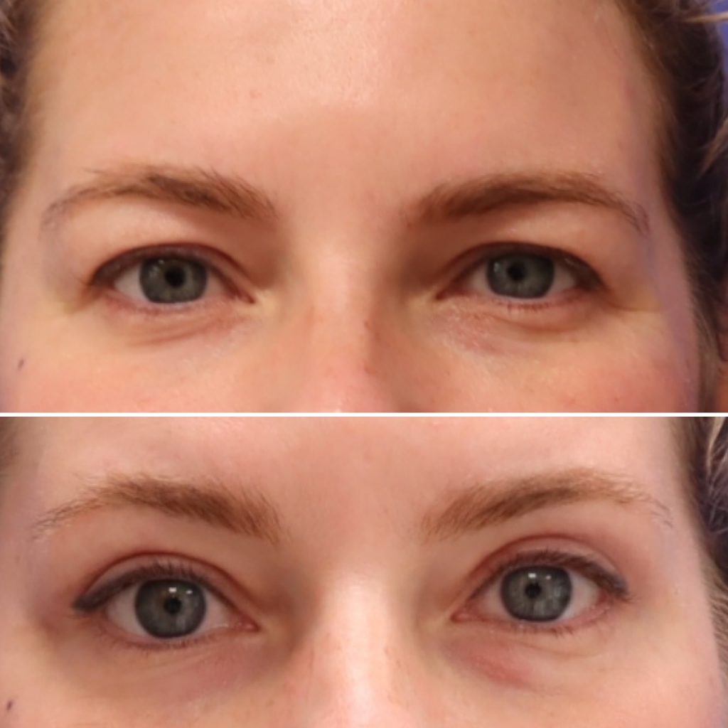 Before and After - Upper Blepharoplasty