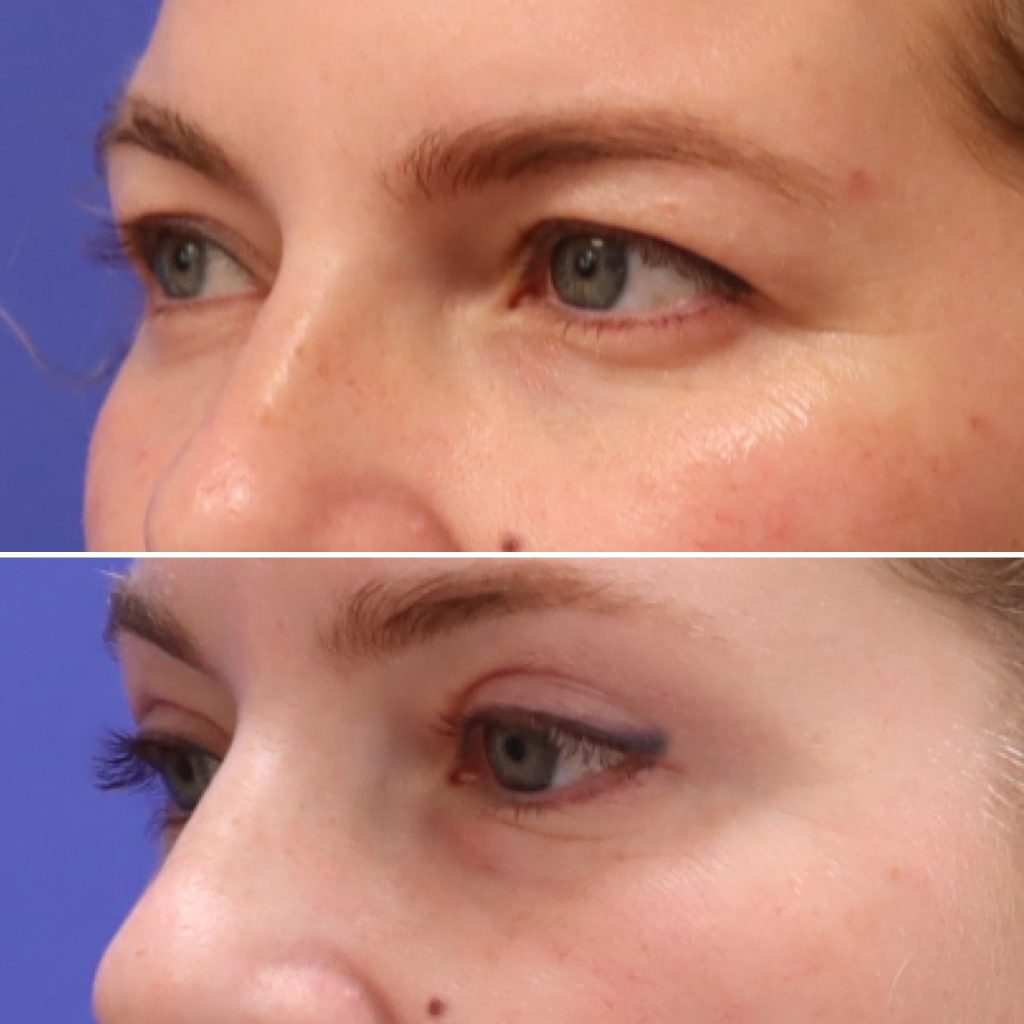 Before and After - Blefaroplastia superior